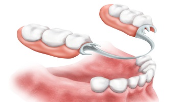 Protesi dentali Monza